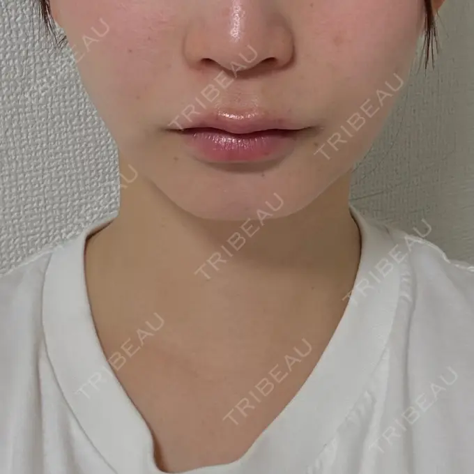 糸リフト / 脂肪吸引（顔） / 脂肪吸引（二の腕） / 脂肪吸引（脚） / 脂肪吸引（お腹） / 脂肪吸引（お尻） / 脂肪吸引（腰） / 脂肪吸引（背中） / 脂肪吸引（肩） ヴェルトラクリニック 新宿院 AFTER メイン用