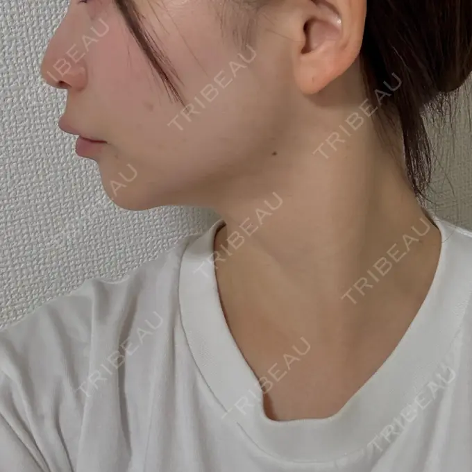 糸リフト / 脂肪吸引（顔） / 脂肪吸引（二の腕） / 脂肪吸引（脚） / 脂肪吸引（お腹） / 脂肪吸引（お尻） / 脂肪吸引（腰） / 脂肪吸引（背中） / 脂肪吸引（肩） ヴェルトラクリニック 新宿院 DAY 116 メイン用