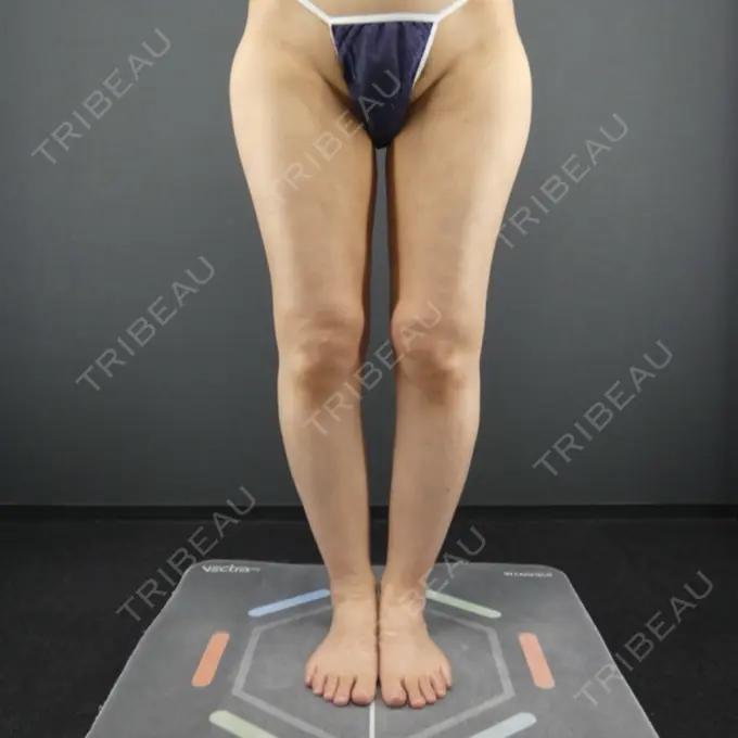 脂肪吸引（脚） / 豊胸（脂肪注入） / 脂肪吸引（腰） GRACIA clinic 【グラシアクリニック】 DAY 195 メイン用