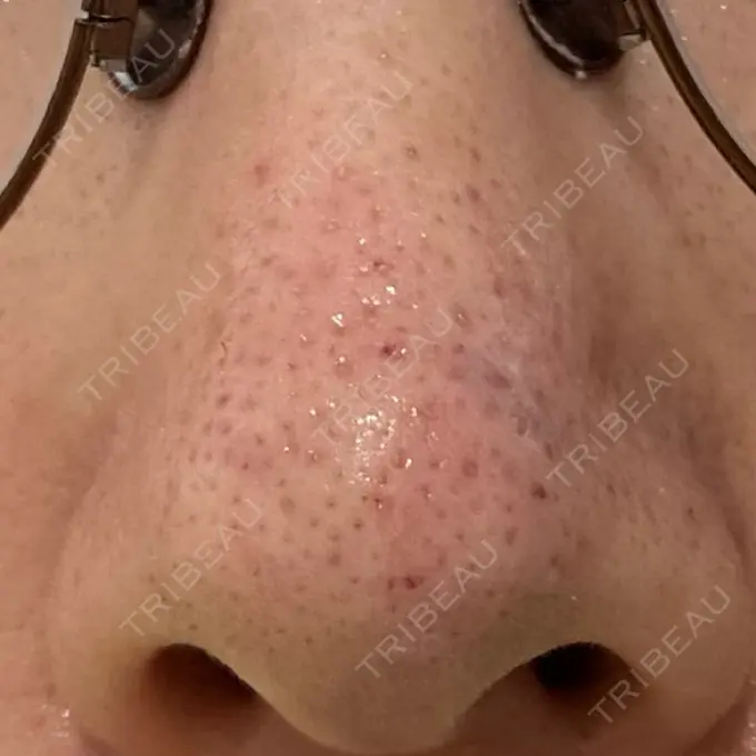 アグネス 日本美容・医療クリニック 六本木院 DAY 4 メイン用