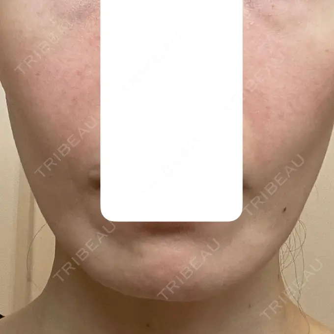 肌育注射（ジュベルックなど） 城本クリニック 長崎院 DAY 3 メイン用