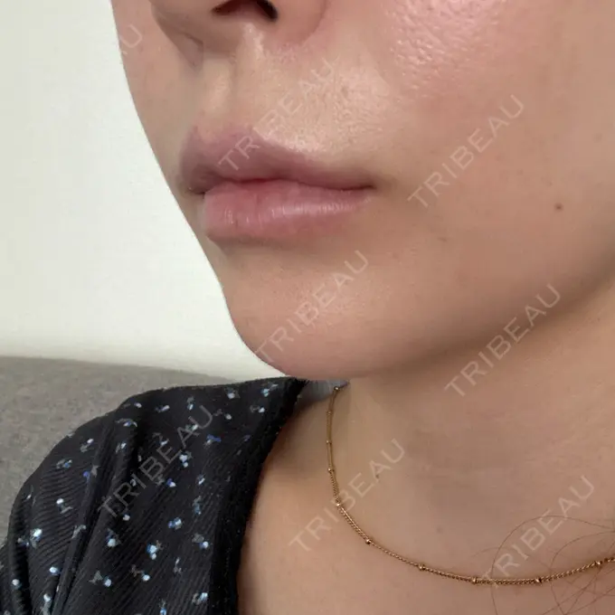 肌ヒアルロン酸注入（たるみ・シワ改善） / ヒアルロン酸注入（唇） 東京シルククリニック 東京神田院 DAY 9 メイン用