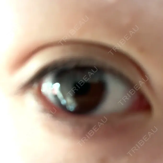 二重埋没 / ヒアルロン酸注入（涙袋） / ボトックス（エラ・小顔） / ヒアルロン酸注入（唇） / ボトックス（眉間） ネビュラクリニック 東京錦糸町院 DAY 34 メイン用