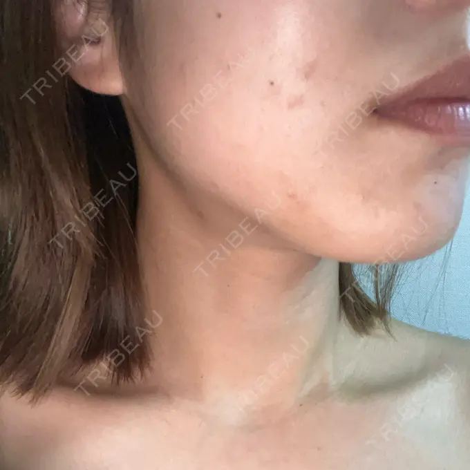 ボトックス（エラ・小顔） 共立美容外科 立川院 DAY 0 メイン用