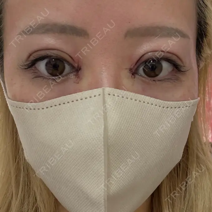 二重埋没 / 目頭切開 eクリニック 福岡院 DAY 0 メイン用