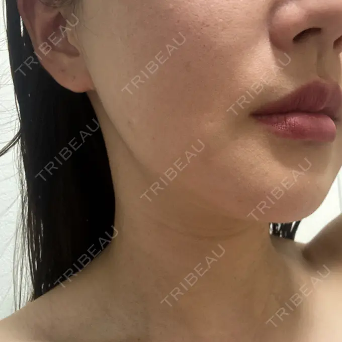 RF（高周波）たるみ治療 RIVER CLINIC（リバークリニック） AFTER メイン用