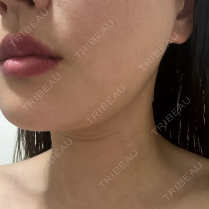 RF（高周波）たるみ治療 RIVER CLINIC（リバークリニック） DAY 7 メイン用