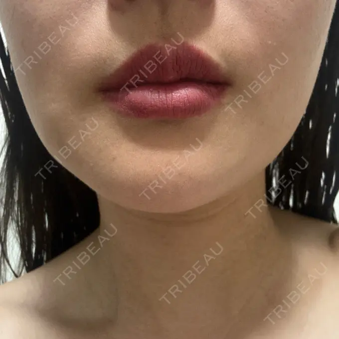 RF（高周波）たるみ治療 RIVER CLINIC（リバークリニック） DAY 7 メイン用