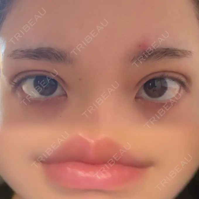 二重埋没 / ヒアルロン酸注入（唇） アリエル美容クリニック 横浜院 DAY 4 メイン用