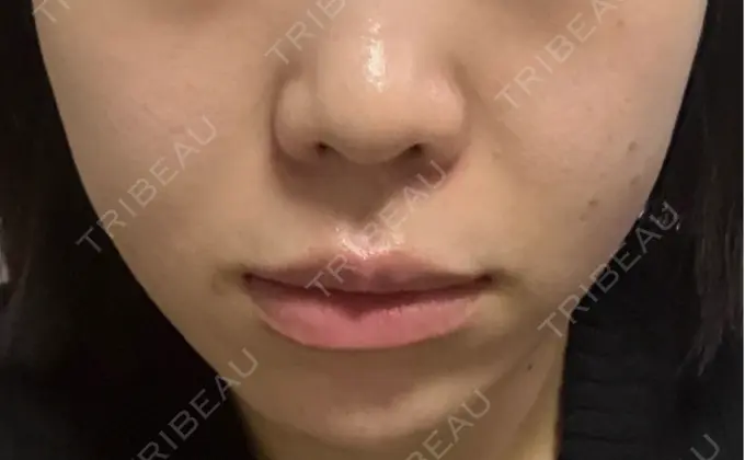 RF（高周波）たるみ治療 RIVER CLINIC（リバークリニック） DAY 0 メイン用