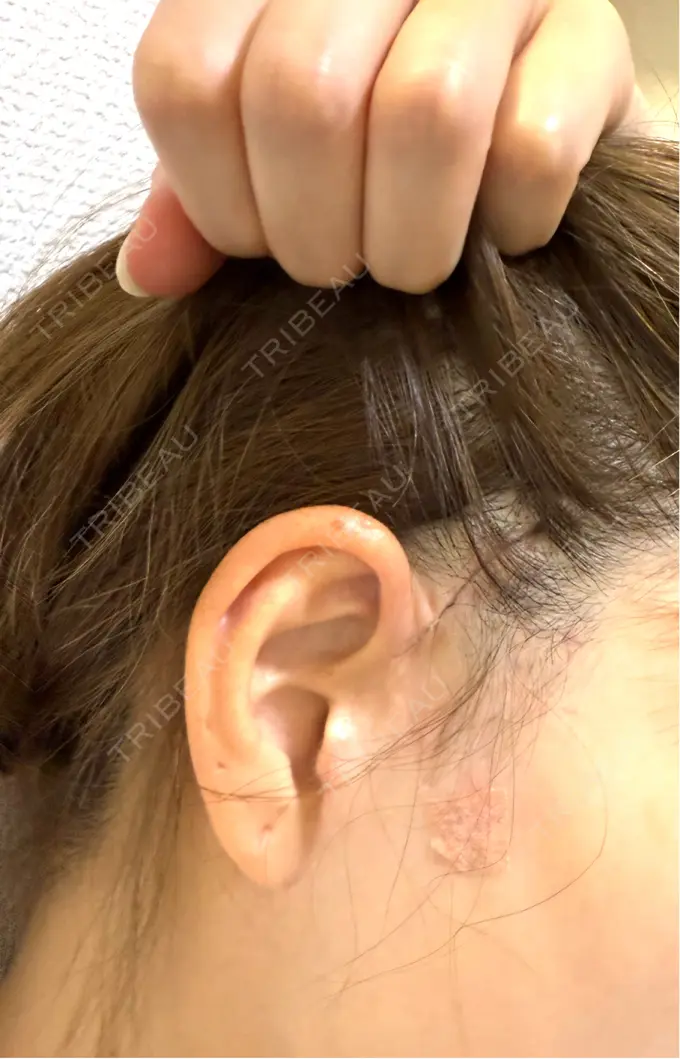 切開リフト GRACY TOKYO CLINIC【グレイシートウキョウクリニック】 DAY 10 メイン用