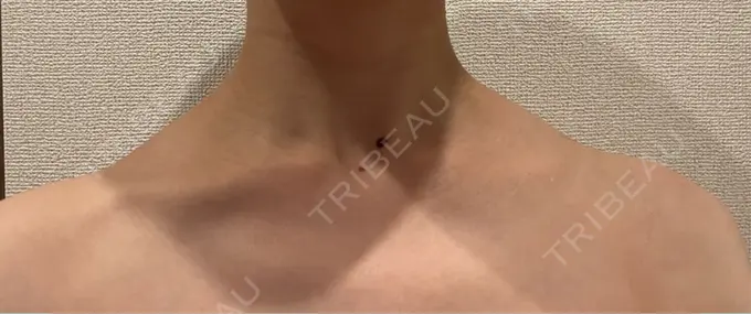 ボトックス（肩） ルラ美容クリニック 静岡院 AFTER メイン用