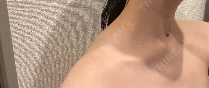 ボトックス（肩） ルラ美容クリニック 静岡院 DAY 21 メイン用