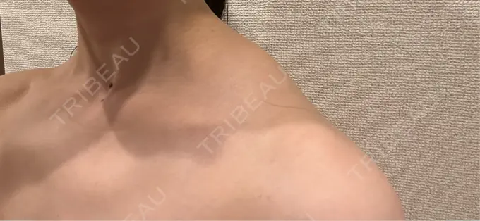 ボトックス（肩） ルラ美容クリニック 静岡院 DAY 21 メイン用