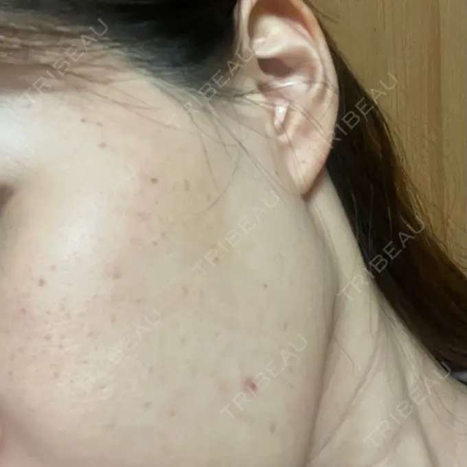 ショッピングリフト BAO CLINIC 心斎橋院 AFTER メイン用