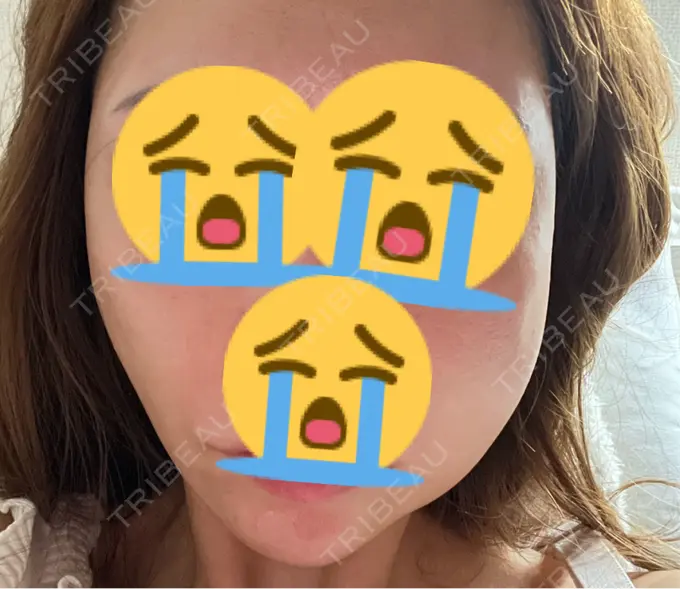 糸リフト MAクリニック 心斎橋 DAY 1 メイン用