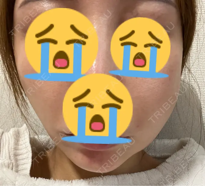 糸リフト MAクリニック 心斎橋 DAY 1 メイン用