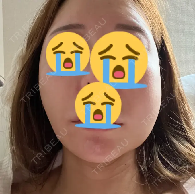 糸リフト MAクリニック 心斎橋 DAY 1 メイン用