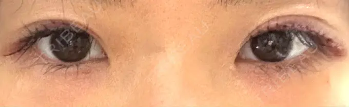 上まぶたたるみ取り / 目元修正 BIANCA銀座 DAY 1 メイン用