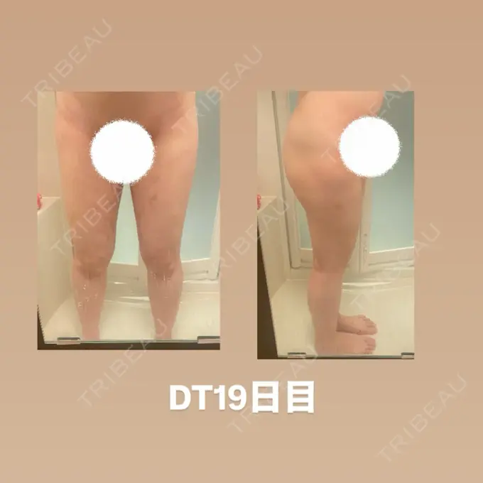 脂肪吸引（脚） 水の森美容クリニック 東京銀座院 DAY 19 メイン用