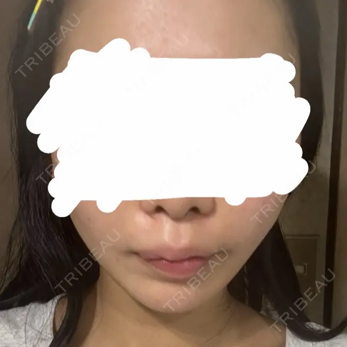 糸リフト / 脂肪吸引（顔） / ジョールファット除去 / 脂肪吸引注射（顔） SEA CLINIC（シークリニック） DAY 1 メイン用