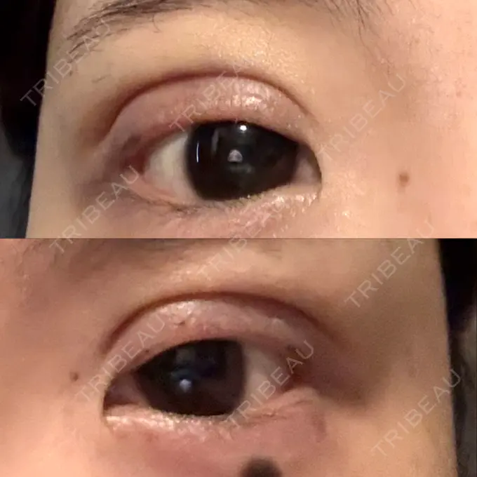 二重埋没 / ボトックス（あご） / ヒアルロン酸注入（あご） / ボトックス（エラ・小顔） アリエル美容クリニック 水戸院 DAY 1 メイン用