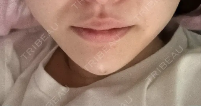 二重埋没 / ボトックス（あご） / ヒアルロン酸注入（あご） / ボトックス（エラ・小顔） アリエル美容クリニック 水戸院 DAY 1 メイン用