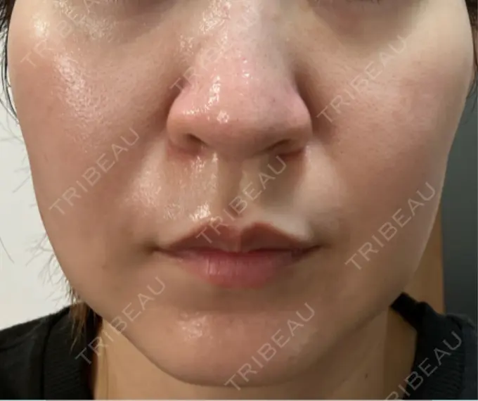 医療脱毛（顔） 渋谷美容外科クリニック 横浜院 DAY 6 メイン用