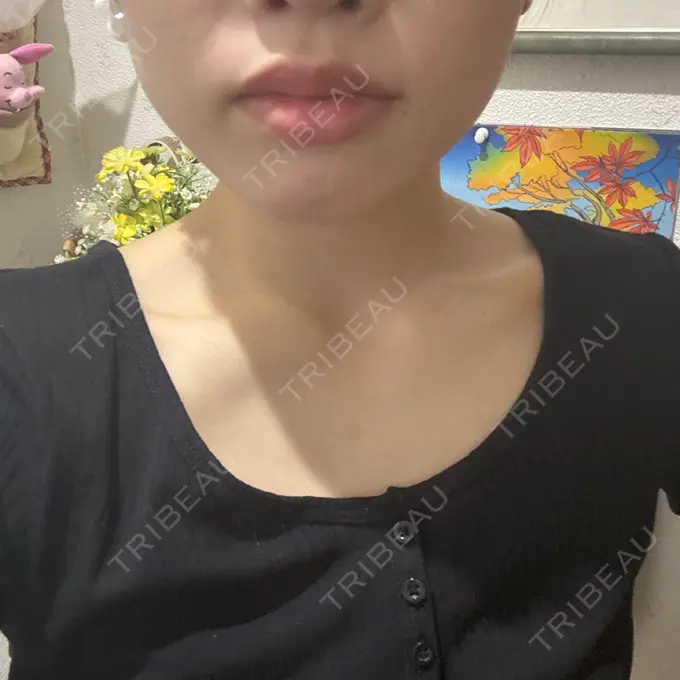 ボトックス（エラ・小顔） 新未来クリニック AFTER メイン用