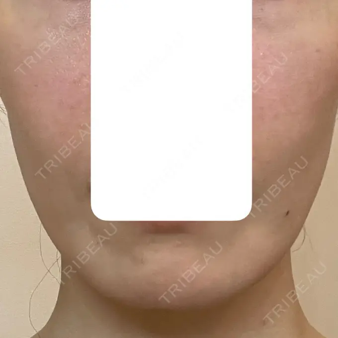 肌育注射（ジュベルックなど） 城本クリニック 長崎院 DAY 4 メイン用