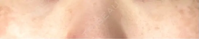 クマ治療 / ボトックス（エラ・小顔） TCB東京中央美容外科 自由が丘院 AFTER メイン用