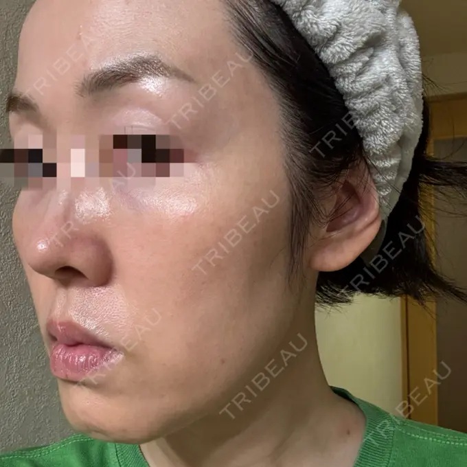 美容点滴・美容注射（美肌） / 白玉点滴・注射 / 美肌レーザー / シミ取りレーザー / 美白レーザー / ピコレーザートーニング（美白・肝斑） / レーザートーニング（美白・肝斑） LE CLINIC DAY 0 メイン用