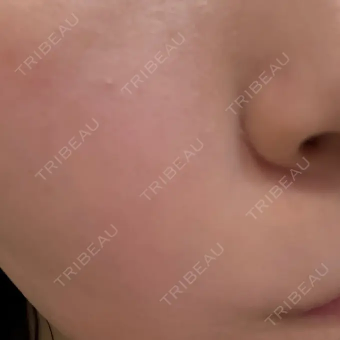 ピーリング（ハリ・ツヤ） Sea Sail Beauty Clinic AFTER メイン用