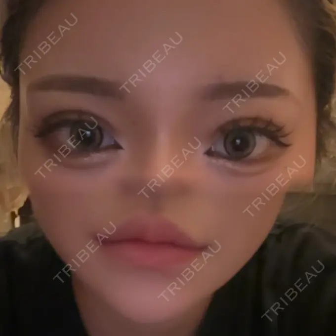 二重埋没 / ヒアルロン酸注入（唇） アリエル美容クリニック 横浜院 DAY 5 メイン用