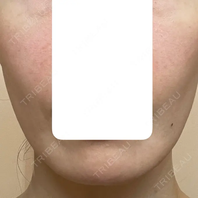 肌育注射（ジュベルックなど） 城本クリニック 長崎院 DAY 5 メイン用