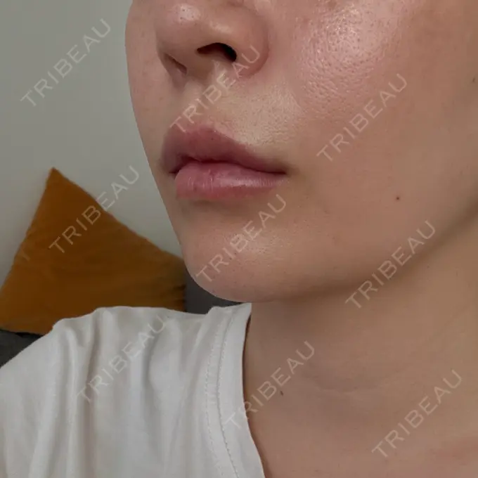 肌ヒアルロン酸注入（たるみ・シワ改善） / ヒアルロン酸注入（唇） 東京シルククリニック 東京神田院 DAY 11 メイン用