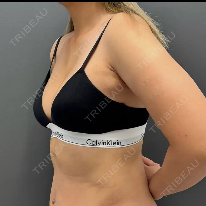 豊胸（脂肪注入） plume clinic DAY 28 メイン用