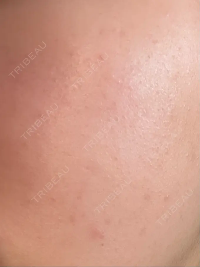 ルメッカ Grias clinic （ジリアスクリニック） DAY 6 メイン用