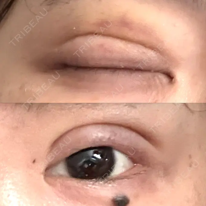 二重埋没 / ボトックス（あご） / ヒアルロン酸注入（あご） / ボトックス（エラ・小顔） アリエル美容クリニック 水戸院 DAY 2 メイン用