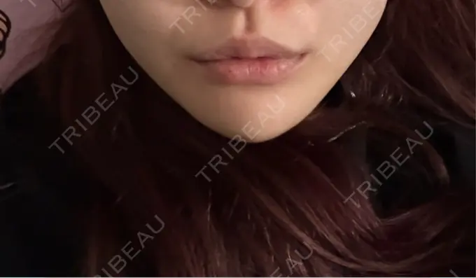 二重埋没 / ボトックス（あご） / ヒアルロン酸注入（あご） / ボトックス（エラ・小顔） アリエル美容クリニック 水戸院 DAY 2 メイン用