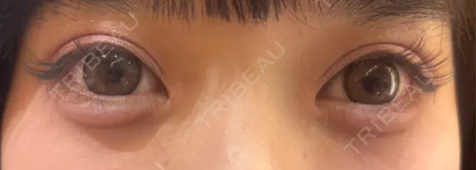 二重埋没 R Beauty CLINIC 銀座院 AFTER メイン用