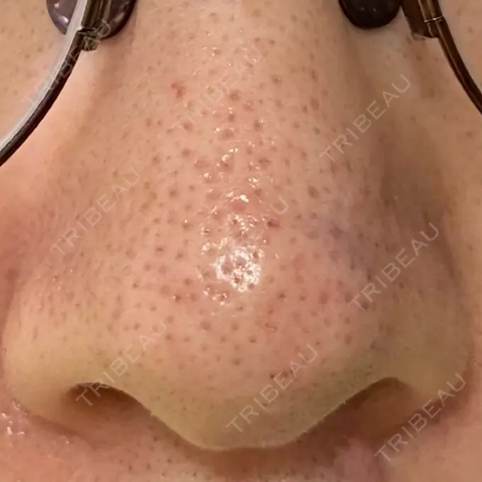 アグネス 日本美容・医療クリニック 六本木院 DAY 5 メイン用