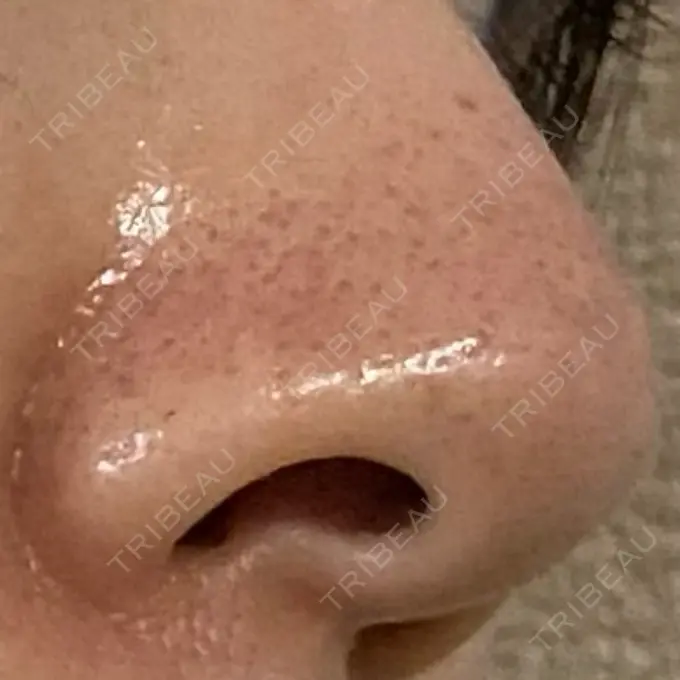 アグネス 日本美容・医療クリニック 六本木院 DAY 5 メイン用