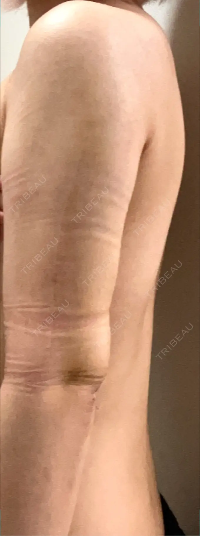 脂肪吸引（二の腕） 豊洲内科・糖尿病 / 形成・美容外科クリニック DAY 1 メイン用