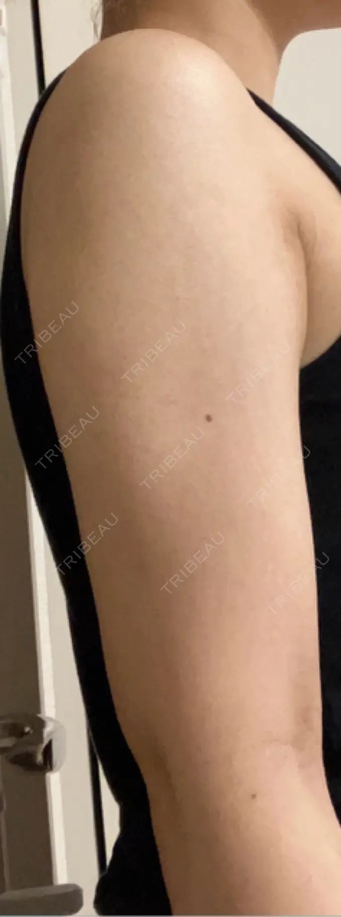 脂肪吸引（二の腕） 豊洲内科・糖尿病 / 形成・美容外科クリニック DAY 5 メイン用