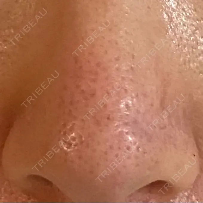 アグネス 日本美容・医療クリニック 六本木院 DAY 6 メイン用