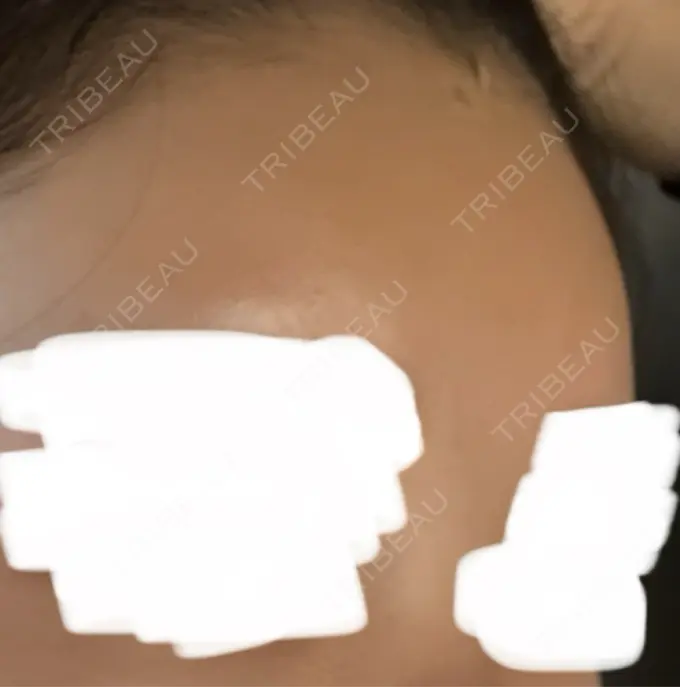 ヒアルロン酸注入（額） / ヒアルロン酸注入（こめかみ） Wi Clinic （ウィ クリニック）心斎橋院 DAY 2 メイン用