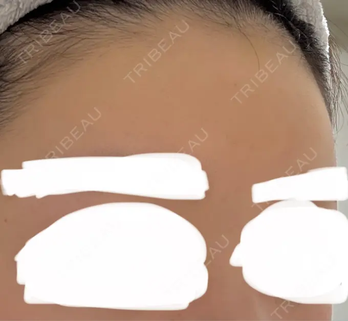 ヒアルロン酸注入（額） / ヒアルロン酸注入（こめかみ） Wi Clinic （ウィ クリニック）心斎橋院 DAY 8 メイン用