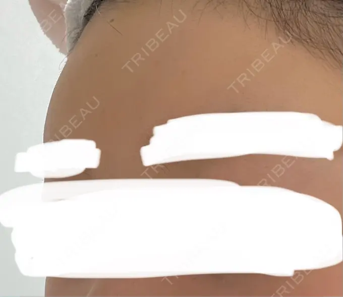 ヒアルロン酸注入（額） / ヒアルロン酸注入（こめかみ） Wi Clinic （ウィ クリニック）心斎橋院 DAY 8 メイン用