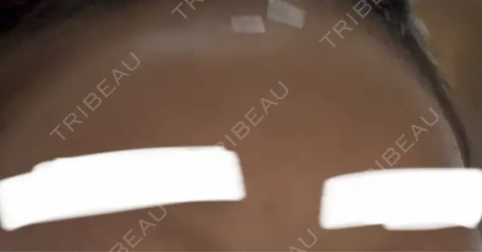 ヒアルロン酸注入（額） / ヒアルロン酸注入（こめかみ） Wi Clinic （ウィ クリニック）心斎橋院 DAY 1 メイン用